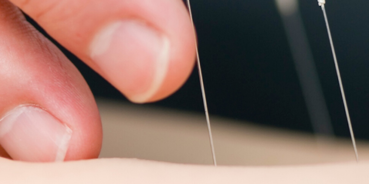 Acupuncture and Dry Needling service photo